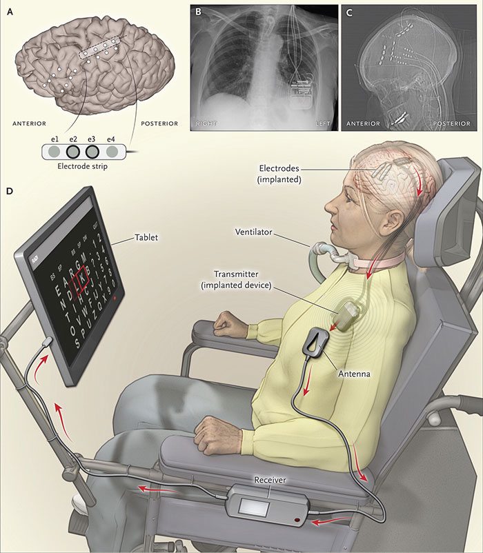 Brain-Implant