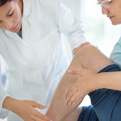 Closeup side view of  female doctor massaging legs and calves of a senior female patient with visible varicose veins.