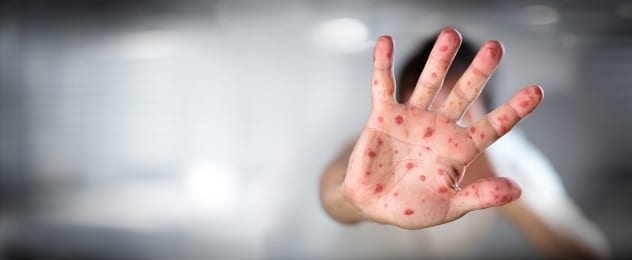 Passengers exposed to measles on flight from Melbourne to Christchurch