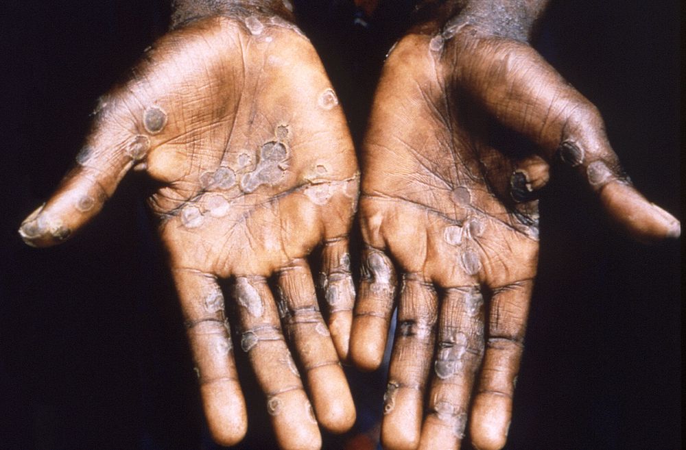 FILE PHOTO: The palms of a monkeypox case patient from Lodja, a city located within the Katako-Kombe Health Zone, are seen during a health investigation in the Democratic Republic of Congo in 1997. Brian W.J. Mahy/CDC/Handout via REUTERS