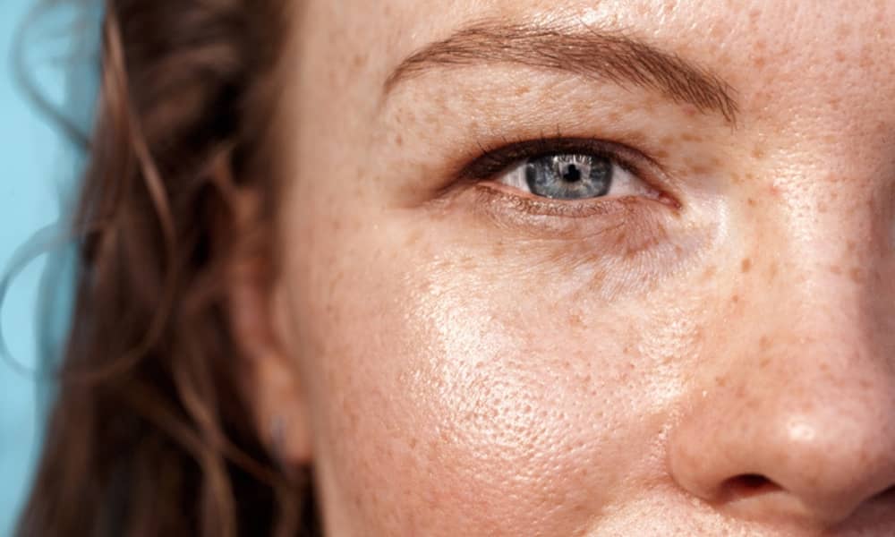 Acne Skincare