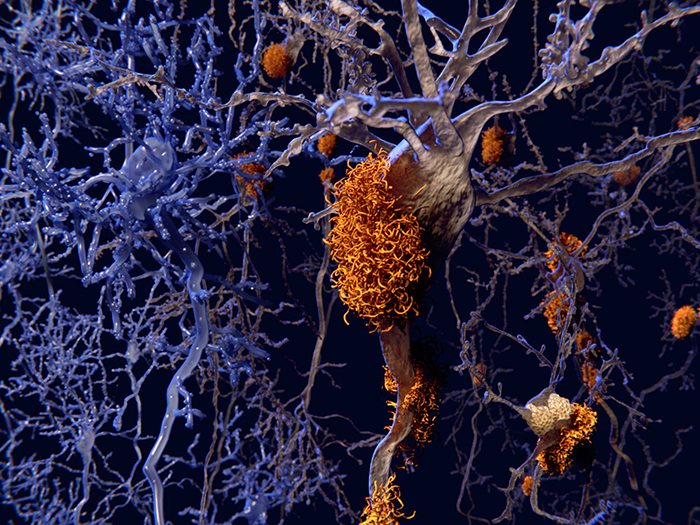 New study finds that controlling brain inflammation could slow progression of Alzheimer’s