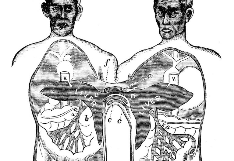 Antique engraving illustration: Siamese Twins