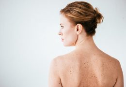 attractive and naked woman with skin sickness on white