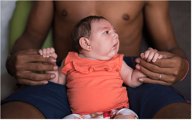 Luiza Arruda was born with a rare condition, known as microcephaly. Luiza's mother Angelica Pereira was infected with the Zika virus, and Brazilian health authorities are convinced that Luiza's condition is related to the Zika virus Photo: AP