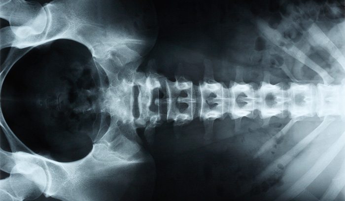 Breakthrough: Could this ‘bionic spine’ help paralysed patients to walk again?